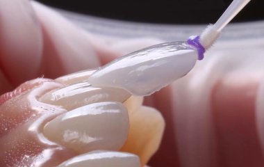 Sứ thủy tinh Lithium disilicate
