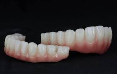Phục hình toàn hàm trên Implant