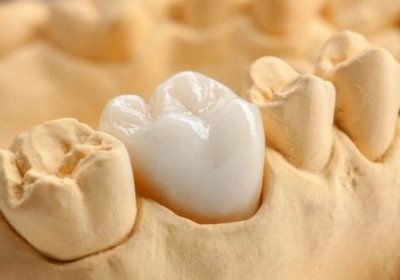 Bọc răng sứ giữ được bao lâu thì phải làm lại?